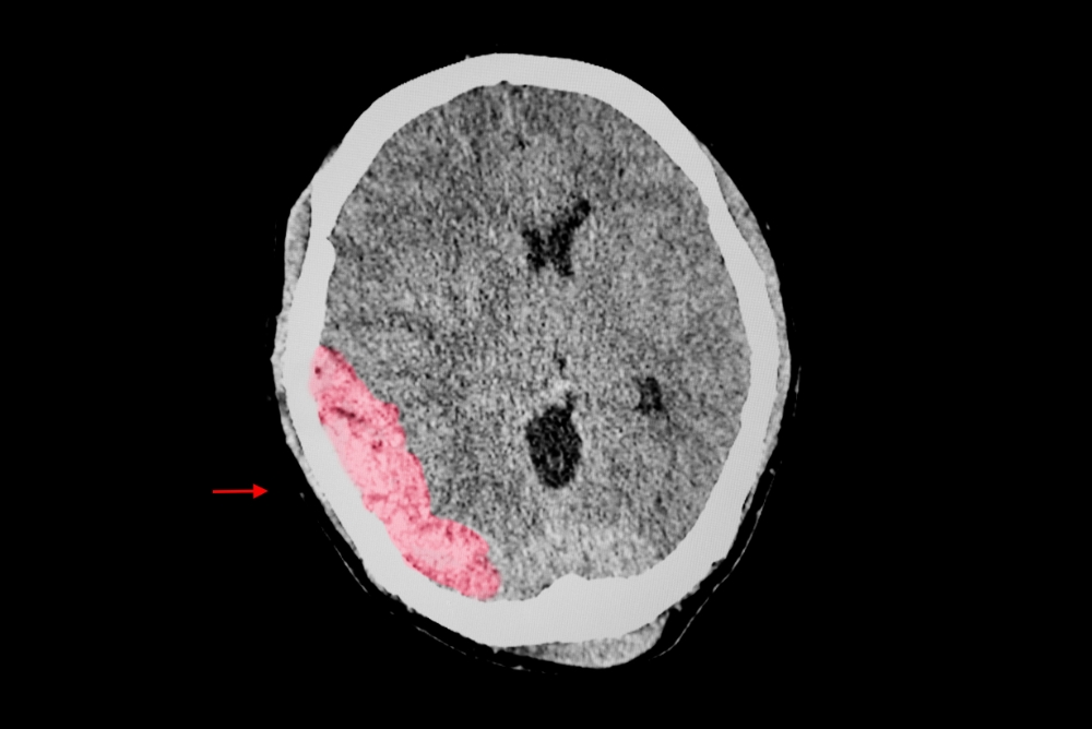 Brain Hemorrhage Types and Diagnostic Methods